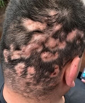 Manchas Oscuras no Pescoço e Axilas: Entendendo o Que Sua Pele Nos Diz